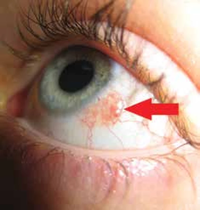 Clinical picture of a patient with papilloma of bulbar conjunctiva
