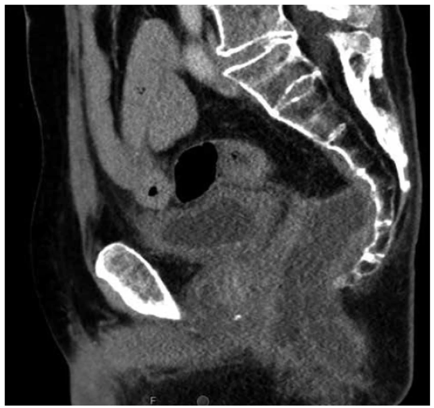 Sagitální řez CT pánve s presakrální abscesovou
formací po amputaci rekta<br>
Fig. 2. Sagittal pelvic CT scan with presacral abscess after
abdominoperineal resection