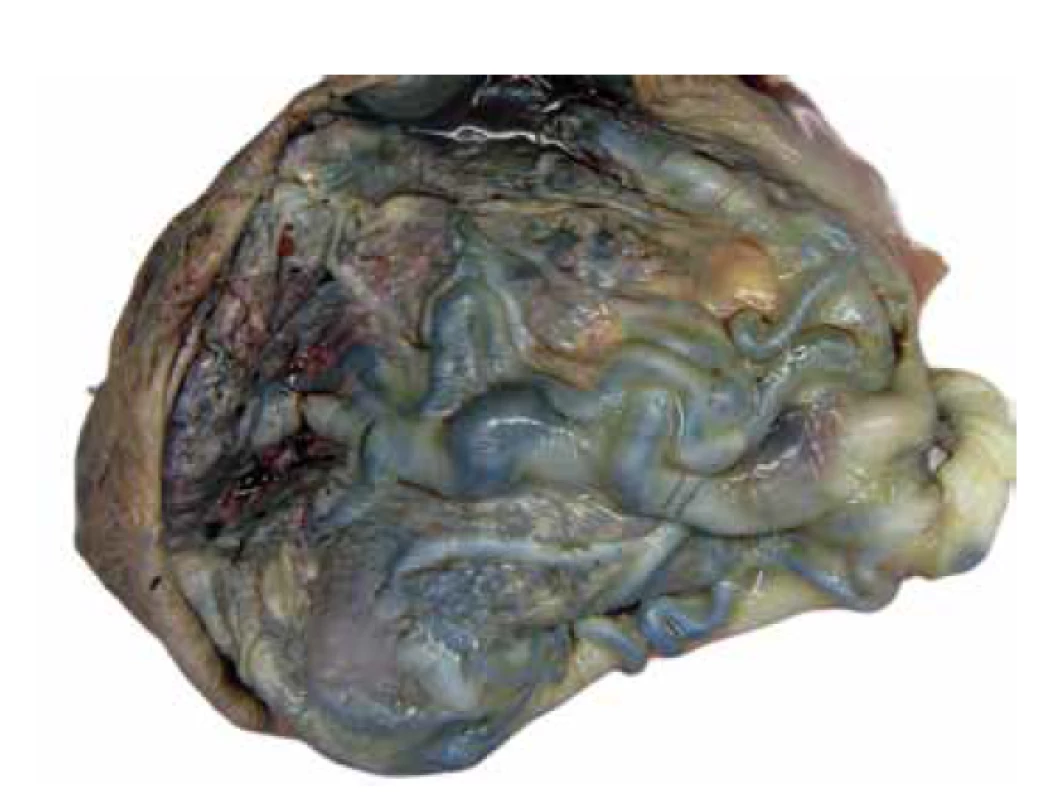 PMD. Objemná placenta (640 g; gr.h. 40+0) s výrazně dilatovanými
cévami choriové plotny.