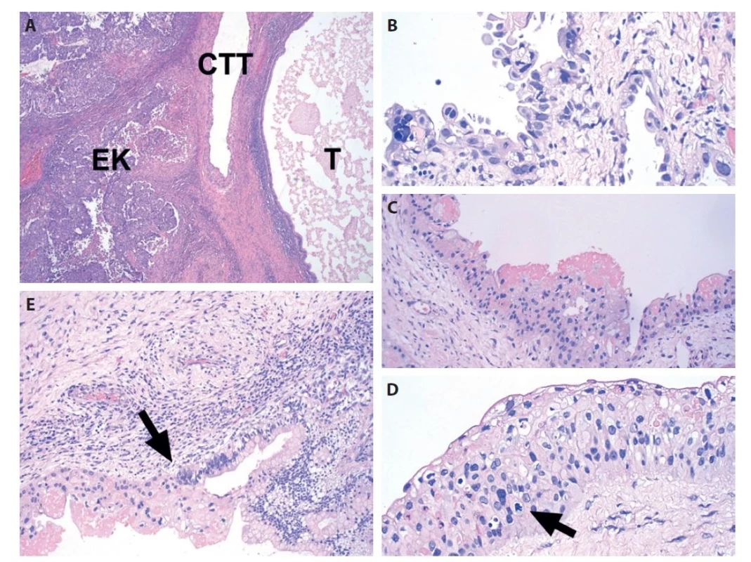 Histomorfologické charakteristiky CTT; A - zmiešaný germinatívny nádor so zastúpením teratómu (T), embryonálneho karcinómu (EK)
a cystického trofoblastického tumoru (CTT) (farbenie H&E; zväčšenie x40); B - detail na cytologické charakteristiky CTT (farbenie H&E; zväčšenie
x400); C - fibrinoidné hmoty (farbenie H&E; zväčšenie x200); D - viacradé usporiadanie nádorových buniek, šípkou označená mitóza (farbenie
H&E; zväčšenie x400); E - priamy prechod (šípka) štruktúr CTT do teratómu zastúpeného cylindrickým epitelom (farbenie H&E; zväčšenie x200).