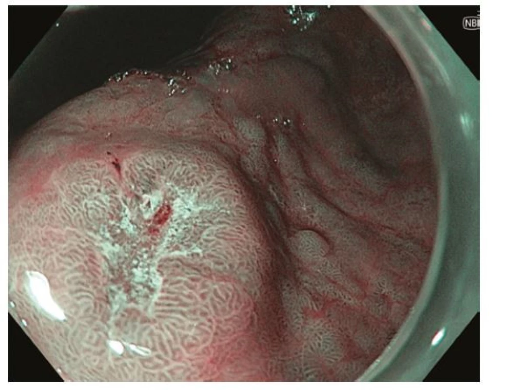 Ložisko časného karcinomu v oblasti antra žaludku – zobrazení
pomocí techniky virtuální chromoendoskopie – NBI (narrow band imaging).
Endoskopicky patrná léze typu 0-IIc dle Pařížské klasifikace se smazanou
povrchovou strukturou a neovaskularizacemi v centrální, vkleslé části léze
