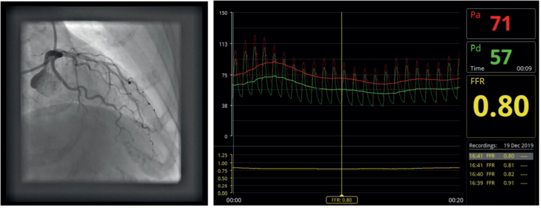 Difuzní postižení ramus interventricularis anterior na hranici funkční významnosti. 8a – angiografie; 8F – FFR; 8c – intrakoronární optická koherentní tomografie s podélným obrazem a vybranými příčnými řezy