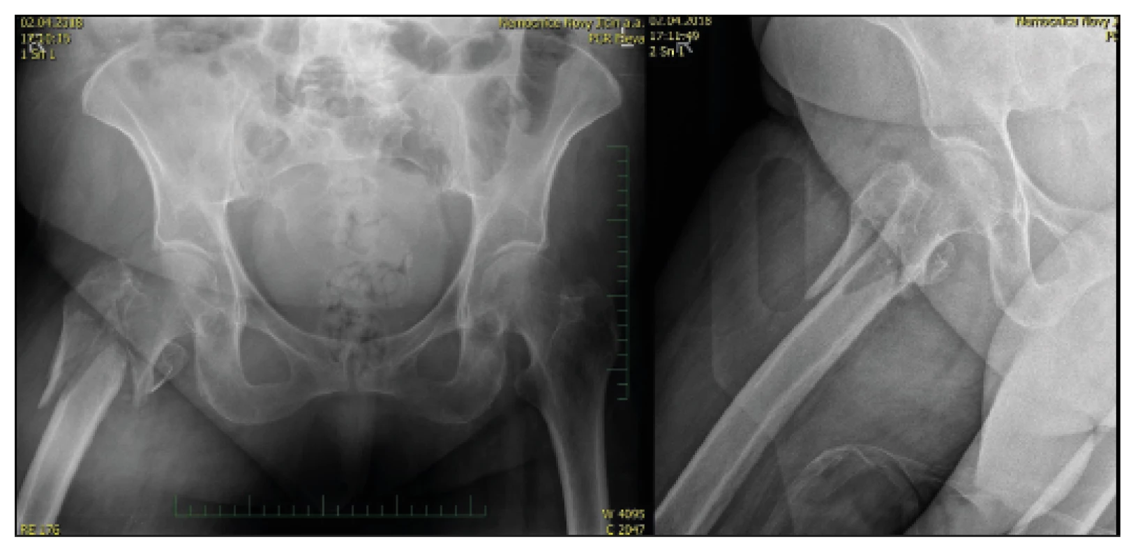 76-year-old female with comminuted fracture of the trochanteric
massive, trauma X-ray