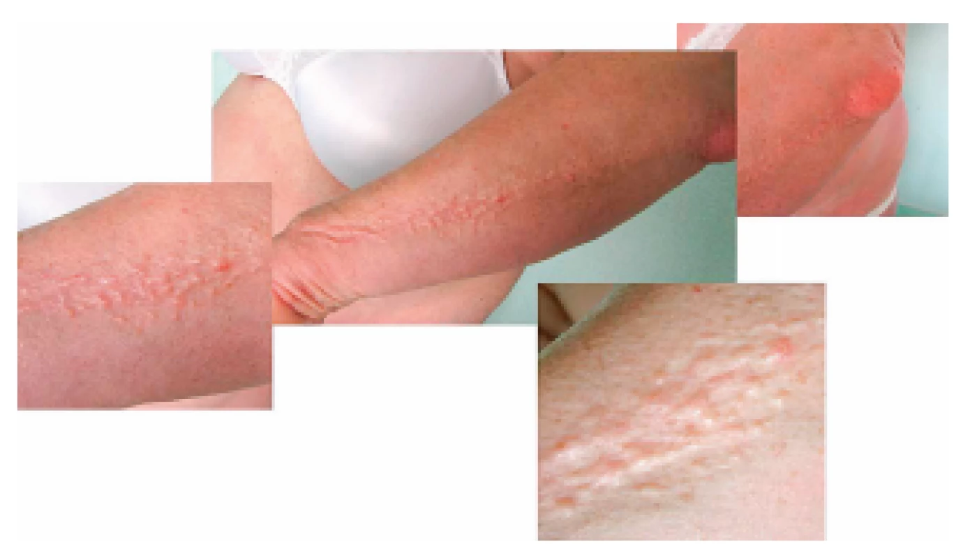 Fotografie kůže pacientky se skleromyxedémem: zřetelná
lineární konfigurace papul
