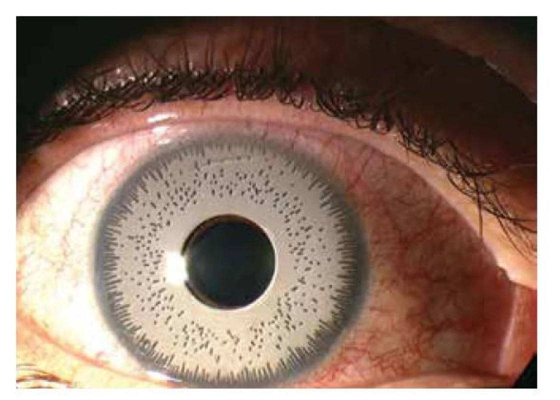 Snímek předního segmentu pravého oka znázorňující
arteficiální kosmetickou duhovku BrightOcular® (Stellar
Devices, New York, USA)