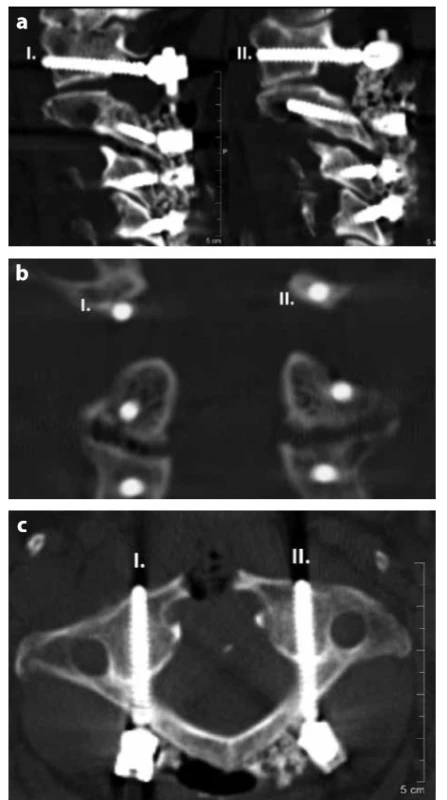 CT zobrazení instrumentace laterální masy C1
cestou přímého zavedení (I.) a cestou inzerce zadního
oblouku atlasu (II.) na příkladu pacienta po transorální
odontoidektomii a zadní stabilizaci C1–-C4; Obr. 1a: v parasagitálních
rekonstrukcích, Obr. 1b: v koronární rovině,
Obr. 1c: v rovině transverzsální<br>
Fig. 1. CT image of C1 lateral mass instrumentation via
direct lateral mass screw insertion (I.) and via PALMS (II.)
in a patient after transoral odontoidectomy and subsequent
posterior C1-C4 stabilization; Fig. 1a: In parasagittal
reconstructions; Fig. 1b: In the coronal plane; Fig.
1c: In the transverse plane