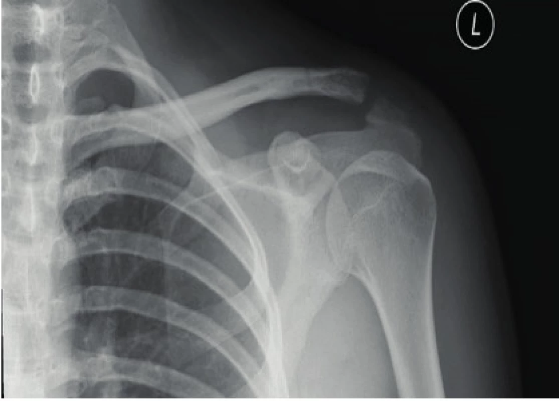 X-ray image of Rockwood type III dislocation – following extraction of the OS material