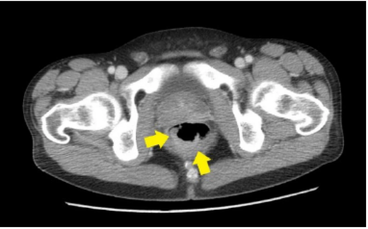 CT nález nízko sediaceho semicirkulárneho tumoru rekta, bez propagácie cez serózny kryt u nášho pacienta (Materiál II. Rádiologickej kliniky LF UK a OÚSA)