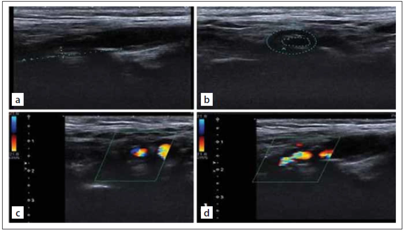 Internal carotid artery imaging. Gray-scale US images of severe (80%) internal
carotid artery stenosis (a, b). Colour Doppler US images of severe (80%) internal
carotid artery stenosis (c, d).<br>
Obr. 1. Zobrazování vnitřní karotidy. UZ zobrazení stupnice šedi těžké (80%) stenózy
vnitřní karotidy (a, b). Barevné dopplerovské UZ zobrazení těžké (80%) stenózy vnitřní
karotidy (c, d).