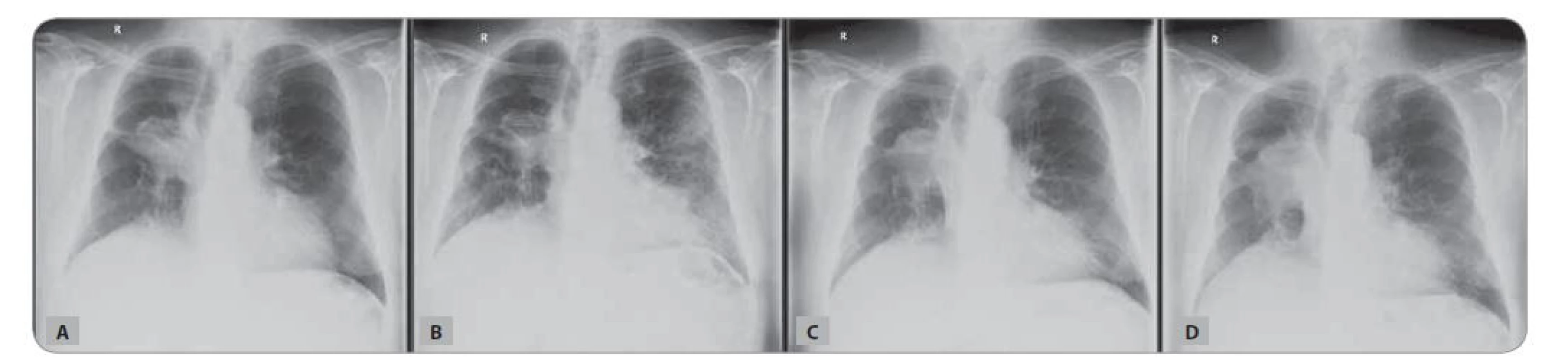 Skiagram hrudníku nemocného z Kazuistiky 2: A) v době zahájení imunoterapie; B) efekt léčby imunoterapií + pneumonie
COVID-19 bilaterálně; C) v době znovuzahájení imunoterapie; D) progrese nemoci při imunoterapii.