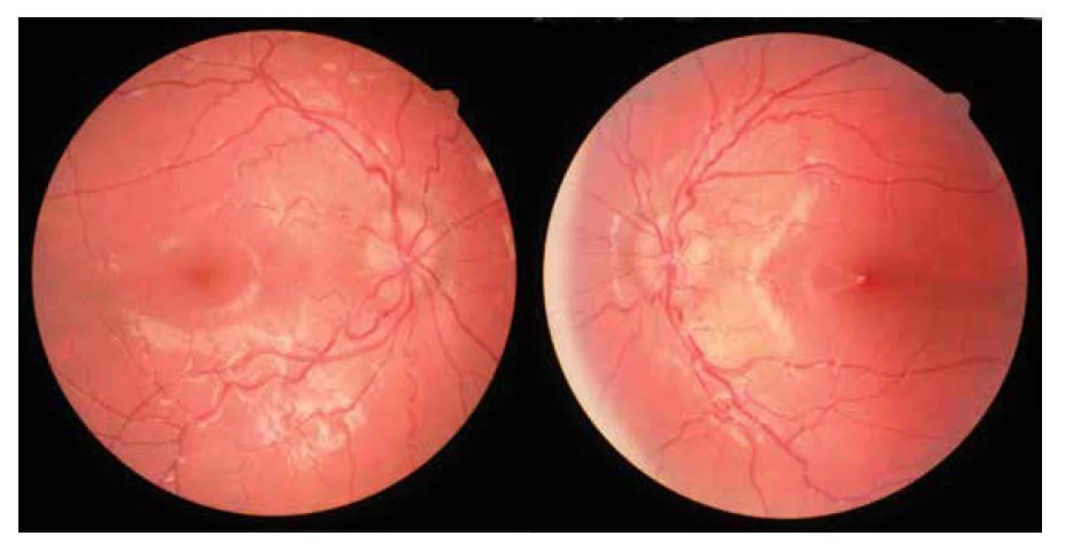 Fotografie očního pozadí pacienta (červenec 2015)