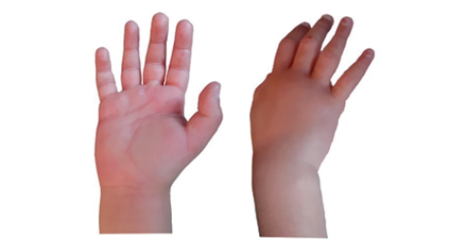 Pacientka 4, edém dlane a dorzálnej časti pravej ruky