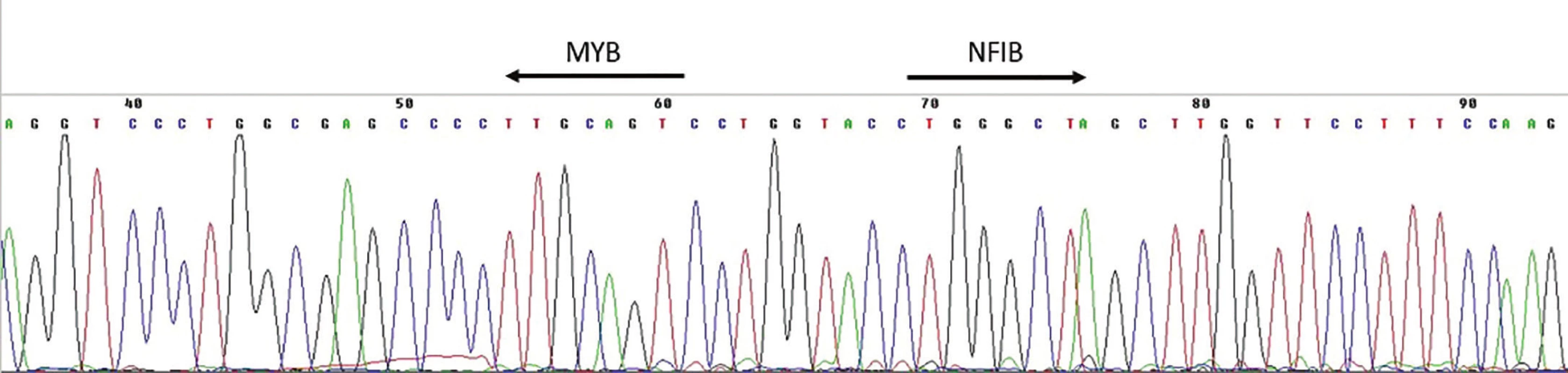 Výsledek sekvenace amplifikačního produktu RT-PCR k průkazu fúzního transkriptu MYB-NFIB.