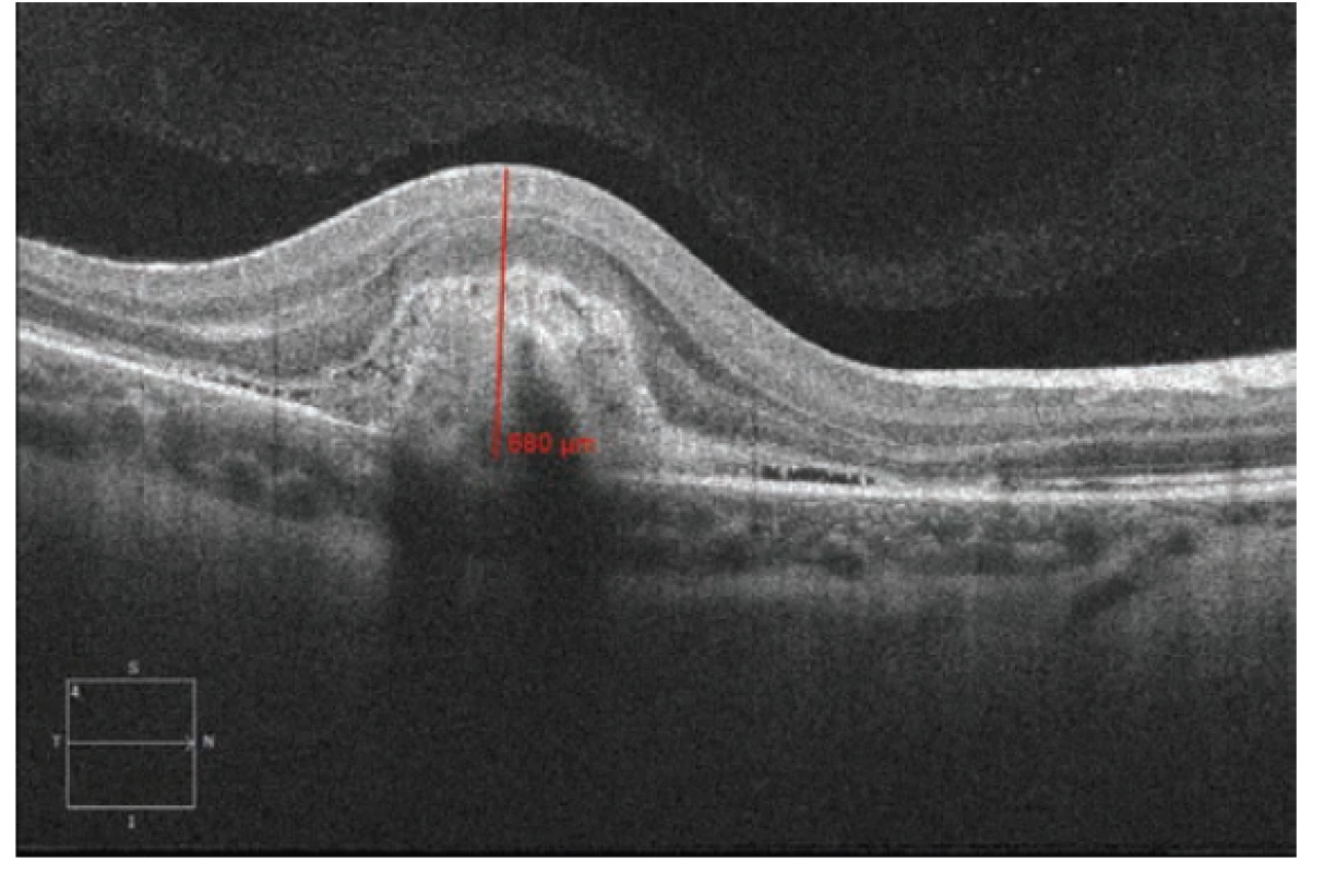 Spectral HD OCT: Linear horizontal transfoveolar scan of right
eye. Significant thickening and increase of volume of macular area,
active CNV with medium reflectivity, flat serous ablation of sensory
epithelium around. Thickness of juxtafoveolar area 680 μm at the
time of diagnosis