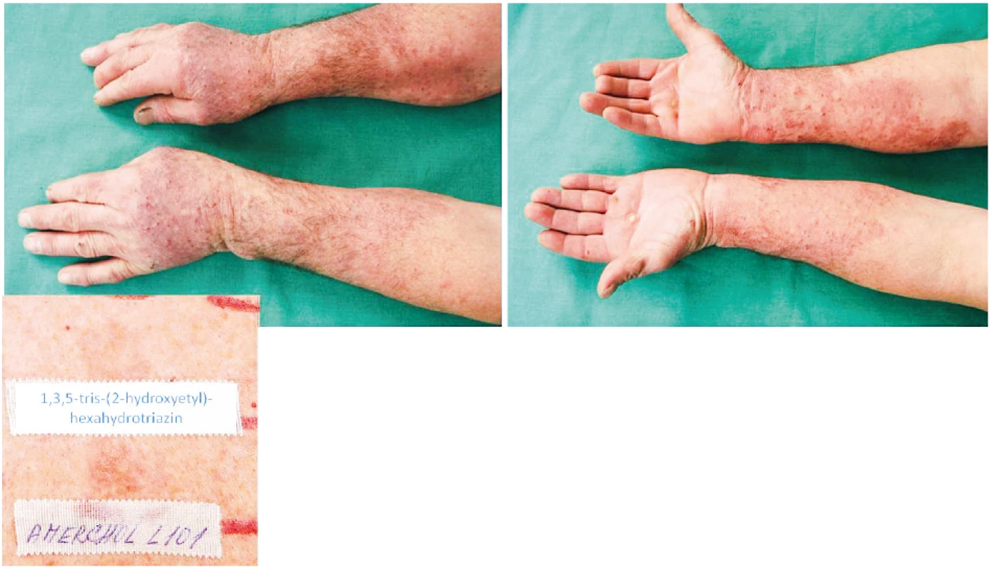 Eczema contactum prof. – 1,3,5-tris(2-hydroxyetyl)-hexahydrotriazin 1%+++, Amerchol
L101++ (průmyslové kapaliny), nikl+, benzalkonium chlorid+++, kokamidopropylbetain++, extr.
Chamomillae+++ (kosmetické přípravky), rtuť++ – obráběč kovů a dělník v galvanovně