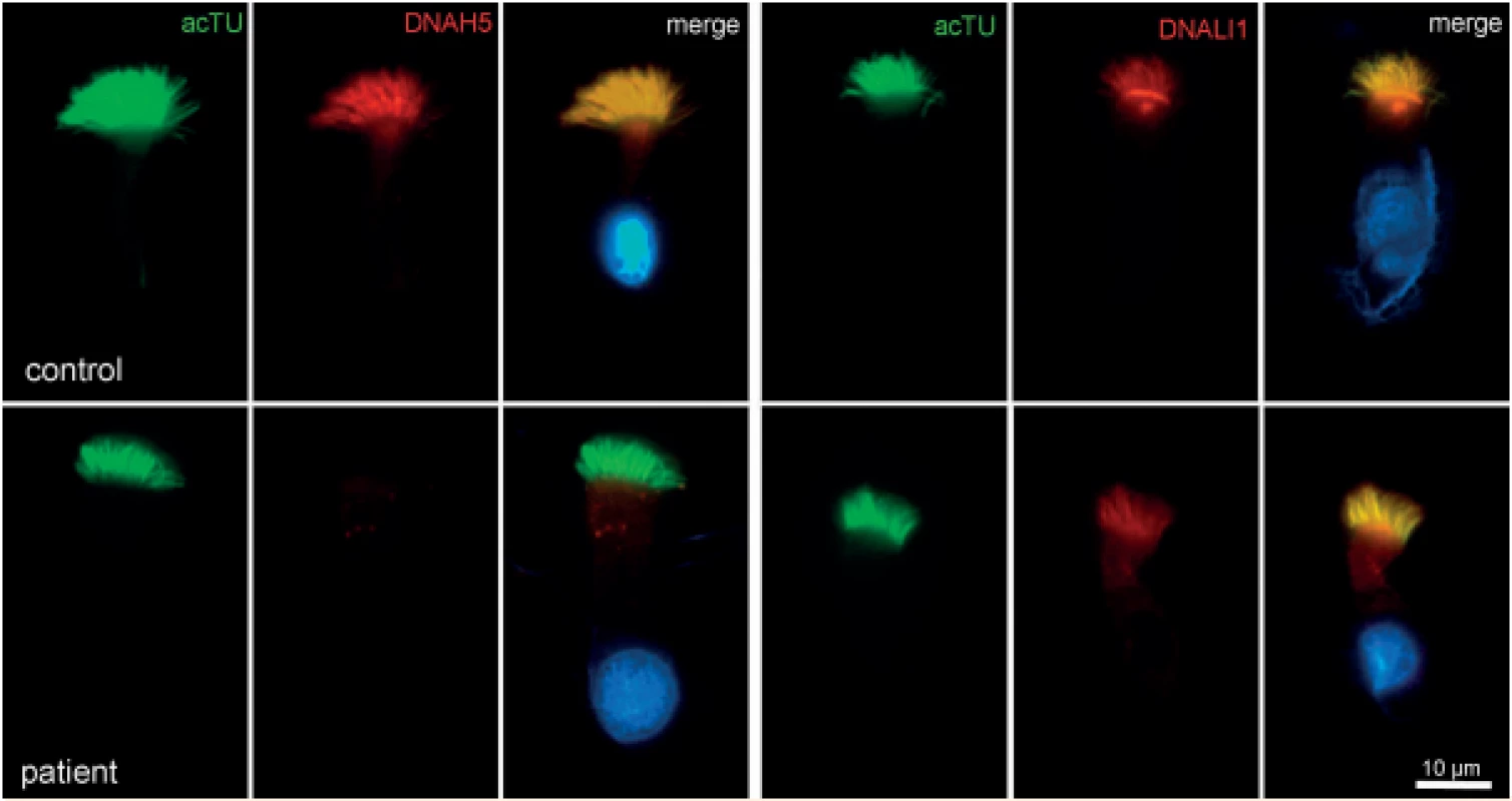 Imunofluorescence – průkaz deficitu zevních dyneinových ramének (ODA) (DNAH5 – marker zevních dyneinových ramének).<br>
Fig. 4. Immunofluorescence – outer dynein arms defect (ODA) (DNAH5 – marker of outer dynein arms).