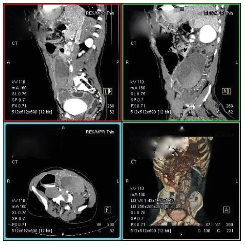 CT nález bloudivé intarzované sleziny