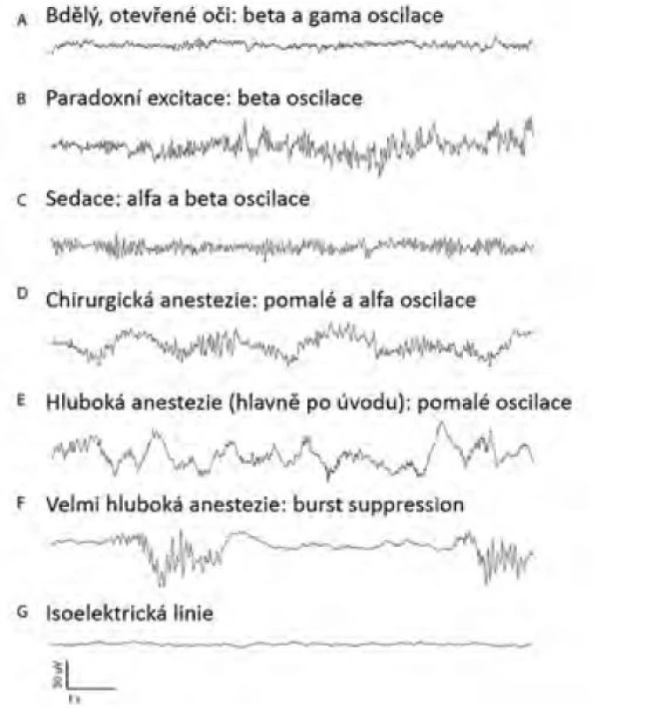 Syrové EEG křivky v anestezii propofolem. Amplituda křivek v
anestezii se při srovnání s křivkou bdělého jedince postupně zvyšuje, kdežto
frekvence oscilací s hloubkou anestezie klesá, objevuje se burst suppression
a nakonec isoelektrická linie. Upraveno z [23]