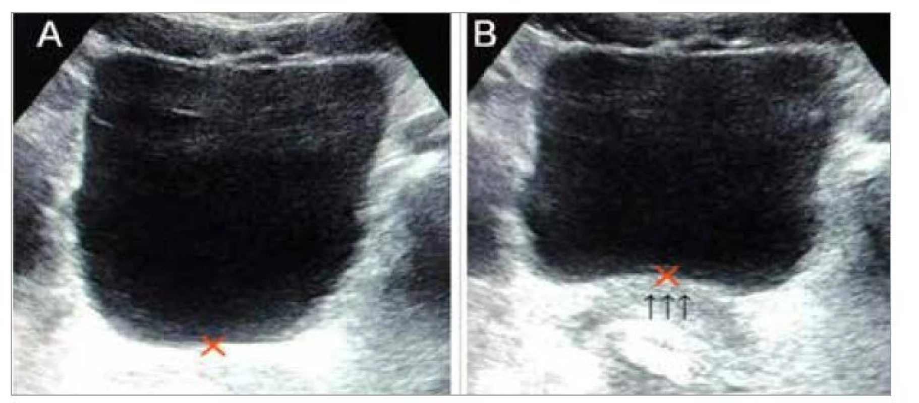 Lift báze močového měchýře (2D ultrazvuk).<br>
1A – výchozí klidová poloha svalů pánevního dna označena křížkem<br>
1B – lift báze močového měchýře vyznačený šipkami<br>
Fig. 1. Lift of the bladder base (2D ultrasound).<br>
1A – initial resting position of the pelvic floor muscles marked with a cross<br>
1B – bladder base lift indicated by arrows
