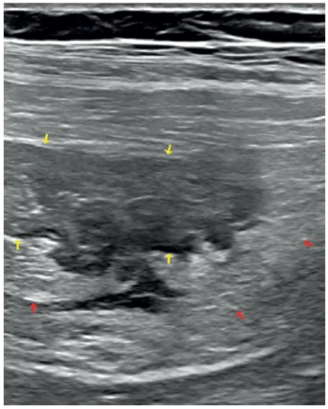 Divertikulitida ilea – ultrazvukové vyšetření břicha,
lineární sonda (12 Hz) <br> 
Fig. 1. Diverticulitis of the ileum – abdominal ultrasound
examination, linear transducer (12 Hz)