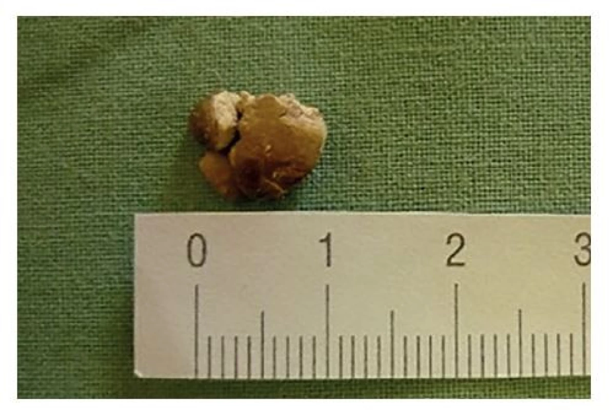 Apendikolit extrahovaný z abscesovej kolekcie<br>
Fig. 3: Appendicolith extracted from the abscess collection