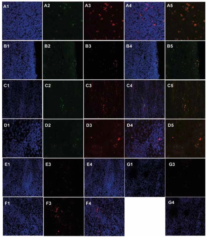 Primary oral keratinocytes and mesenchymal stem cells in post-CED defects 17–36 days after transplantation detected
by confocal microscopy<br>
Fluorescent detection of primary oral keratinocytes (A2, 4, 5, green) and mesenchymal stem cells (A3, 4, 5, red) from pig L139 in
submucosa of the ESD site (A1 – DAPI, A4 merge of A1–3 channels, A5 merge of A2 and A3 channels, 630x magnification). Fluorescent
detection of primary oral keratinocytes (B2, 4, 5, green) and mesenchymal stem cells (B3, 4, 5, red) from pig L139 in cicatricial
mucosa of the ESD site (B1 – DAPI, B4 merge of B1–3 channels, B5 merge of B2 and B3 channels, 630x magnification). Fluorescent
detection of primary oral keratinocytes (C2, 4, 5, green) and mesenchymal stem cells (C3, 4, 5, red) from pig T61 in submucosa of
the ESD site (C1 – DAPI, C4 merge of C1–3 channels, C5 merge of C2 and C3 channels, 630x magnification). Fluorescent detection
of primary oral keratinocytes (D2, 4, 5, green) and mesenchymal stem cells (D3, 4, 5, red) from pig L531 in submucosa of the ESD
site (D1 – DAPI, D4 merge of D1–3 channels, D5 merge of D2 and D3 channels, 630x magnification). Fluorescent detection of
mesenchymal stem cells (E3, 4, red) from pig T79 in submucosa of the ESD site (E1 – DAPI, E4 merge of E1 and E3 channels, 400x
magnification). Fluorescent detection of mesenchymal stem cells (F3, 4, red) from pig T67 in submucosa of the ESD site (F1 – DAPI,
F4 merge of F1 and F3 channels, 400x magnification). Fluorescent detection of mesenchymal stem cells (G3, 4, red) from pig T83 in
submucosa of the ESD site (G1 – DAPI, G4 merge of G1 and G3 channels, 400x magnification).
