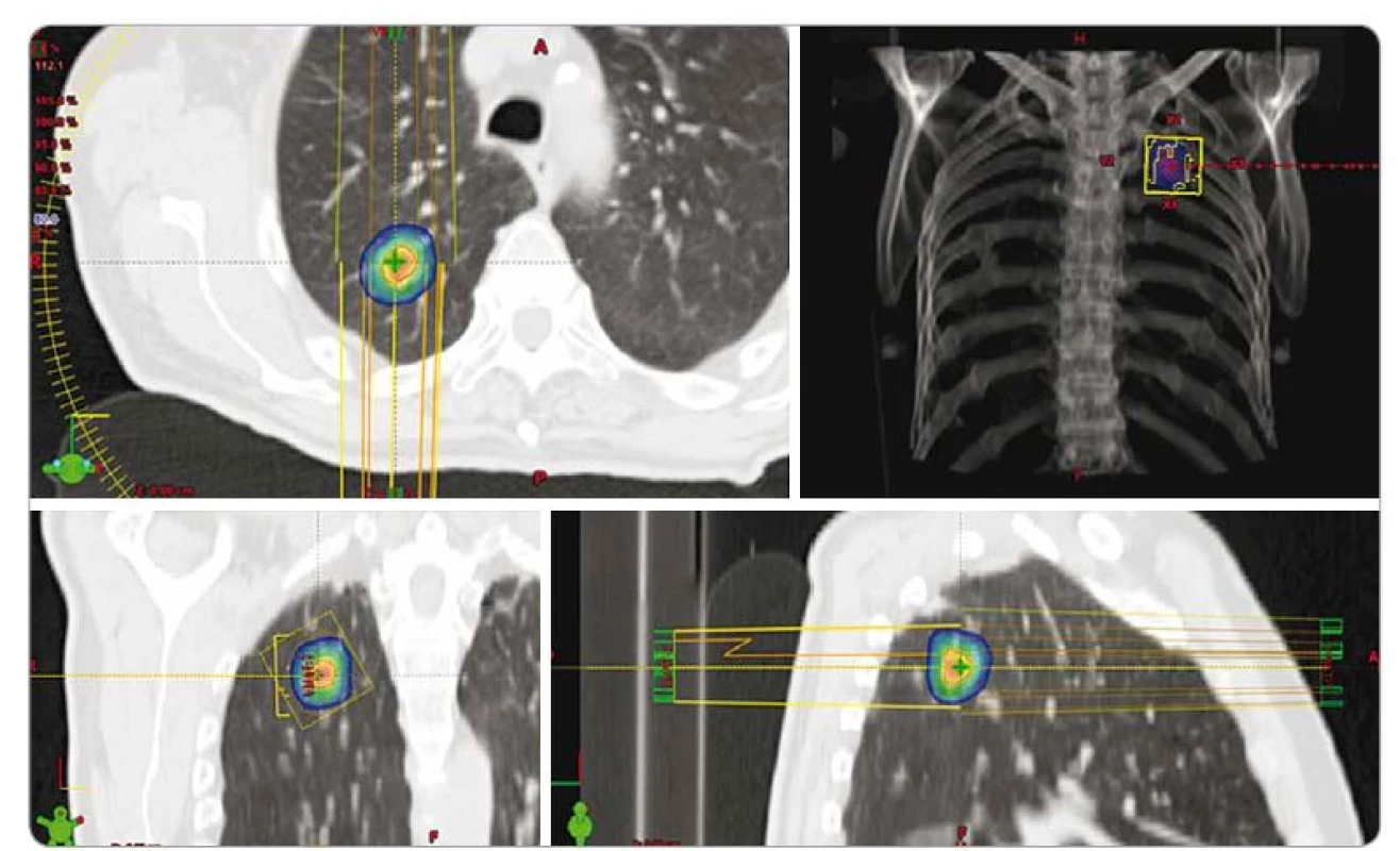 Izodózní plán SBRT spinocelulárního karcinomu pravé plíce u 70letého pacienta, T1a, medicínsky inoperabilní pro četné
vážné komorbidity, dávka 3 × 18 Gy, předpis dávky na 80% izodózu. PTV 20 ccm, D min. 50,1 Gy, D max. 75,7 Gy.
SBRT – extrakraniální stereotaktická radioterapie, PTV – plánovací cílový objem, D – dávka záření, Gy – Gray