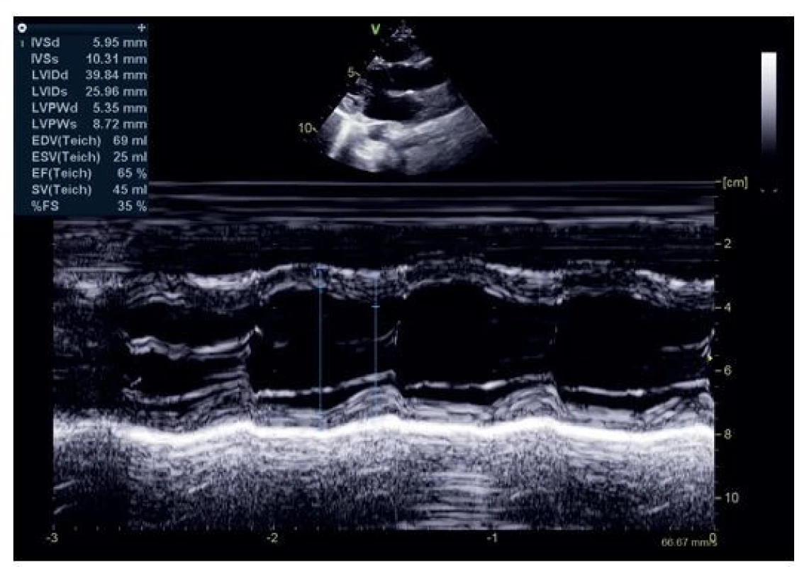 2D echokardiografie, zobrazení levé komory srdeční z parasternální
dlouhé osy, kalkulace ejekční frakce levé komory pomocí
Teichholzovy metody
