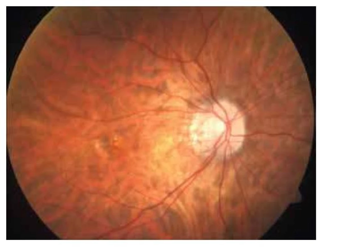 Fotografie sítnice pravého oka. Patrná pigmentovaná
myopická choroidální neovaskulární membrána s drobnou
hemoragií