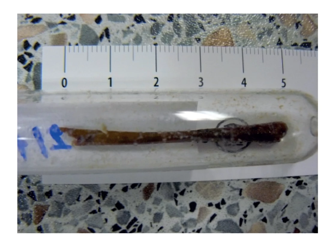 Cizí těleso extrahováné z resekátu<br>
Fig.3: Foreign body extracted from the specimen