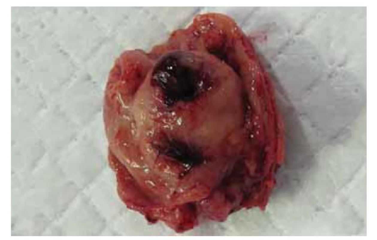 Makroskopický obrázek tumoru z resekátu žaludku.<br>
Fig. 3. Macroscopic image of a tumour from a gastric resection.