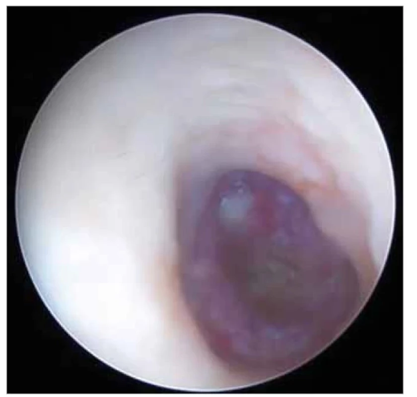 Levý zevního zvukovod a bubínek po sanaci
larev.<br>
Fig. 3. Left external auditory canal and eardrum after sanation
of the maggots.