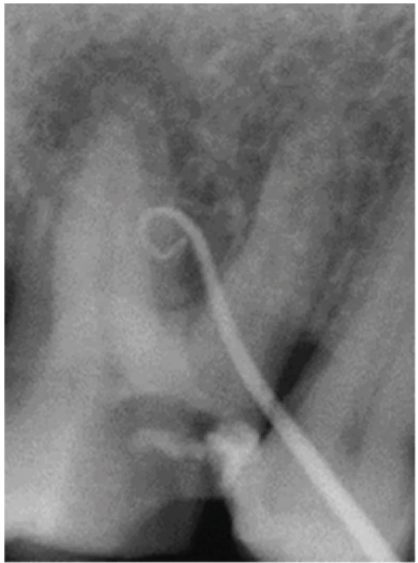 Periapikální snímek<br>
Fig. 7
Periapical radiograph
