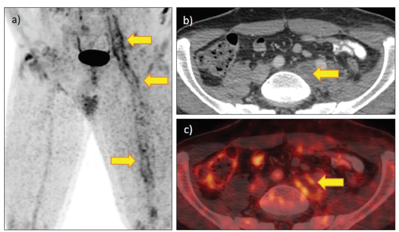 FDG PET/CT u extenzivní subakutní ileofemorální flebotrombózy se zvýšenou akumulací. 52letý pacient s protrahovanou
elevací zánětlivých markerů po komplikované myokarditidě. Synchronní plicní embolie verifikovaná angioCT byla bez akumulace
FDG: a) MIP se zvýšenou akumulací v průběhu hlubokých žil PDK, b) CT s trombem ve v. iliaca communis sin., c) fúze PET/CT se zvýšenou
akumulací v žilní stěně.
