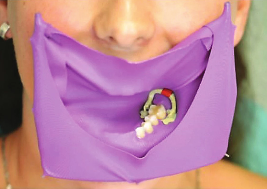 Kofferdam aplikovaný do dutiny ústní<br>
Fig. 1 Rubber dam placed in oral cavity