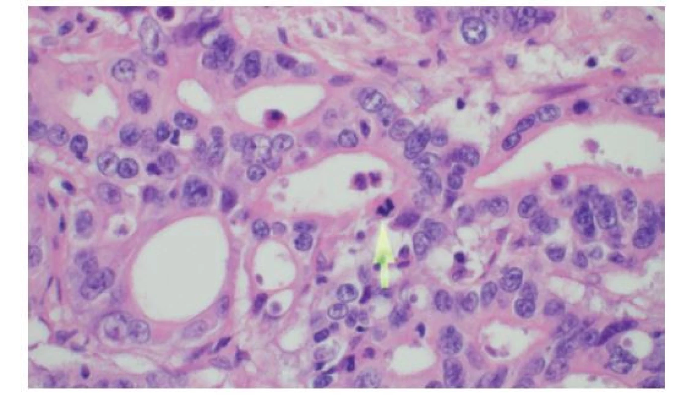 Detail histologie cholangiocelulárního adenokarcinomu
žlučovodu sestávajícího z anastomózujících tubulárních
žlázek<br>
Šipka označuje mitózu, HE, 600×<br>
Fig. 5: Histology of bile duct cholangiocellular adenocarcinoma
consisting of anastomosing tubular glands<br>
The arrow shows the mitotic figure, HE, 600×.