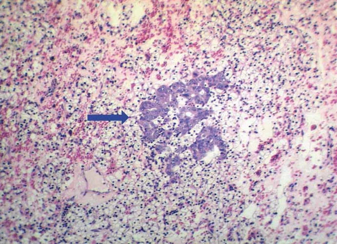 Small focus of metastatic adenocarcinoma (blue arrow) on the background of
clear cell RCC. Metastasis exhibits a typical glandular pattern (hematoxylin & eosin,
magnifi cation 200×).
