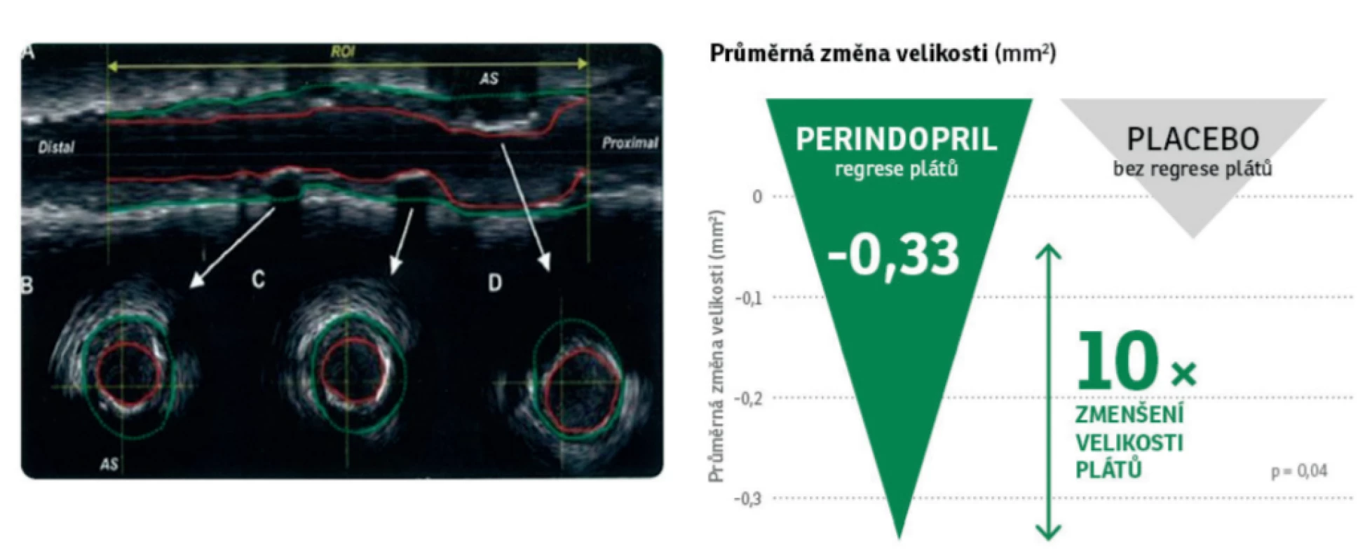 Perindopril: regrese nekalcifikovaných aterosklerotických plátů. Upraveno dle Bruining N et al. Coronary Artery Disease 2009,20: 409–414