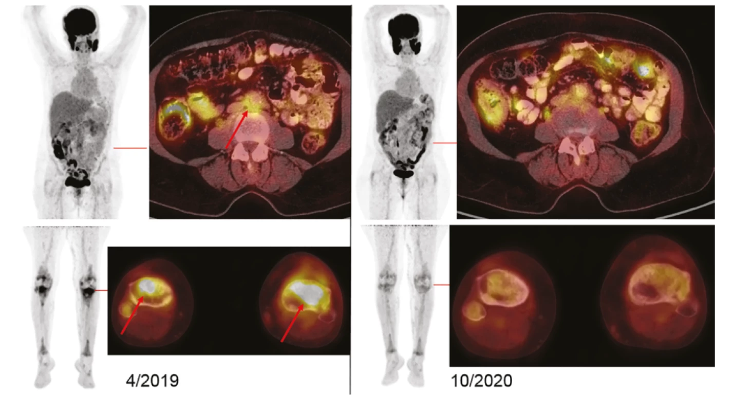 Vizualizace nemoci pomocí FDG-PET/CT vyšetření: Vlevo iniciální sken s MIP projekcí trupu a dolních končetin (v černobílé barevné škále). Červeně
jsou označeny axiální fúzované řezy (v barevné škále Hot Body), s detaily FDG-avidního postižení retroperitonea a proximálních tibií (šipky). Vpravo pak
identické oblasti potvrzující remisi (vymizení akumulací FDG v RP i skeletu). U pacientky se opakovaně zobrazují metabolicky aktivní žvýkací svaly – jako
projev svalové aktivity žvýkání bezprostředně před vyšetřením. Akumulace FDG v mozku, ledvinách, močovém měchýři je fyziologická. Akumulace v tračníku
je variantou fyziologického zobrazení