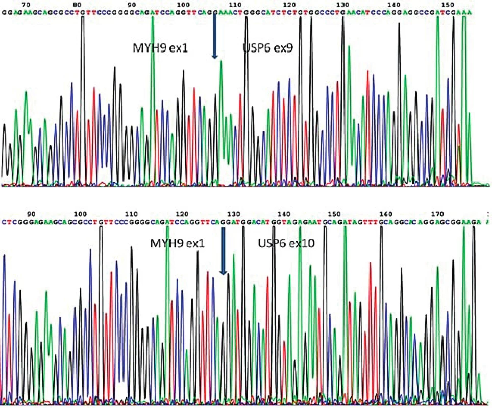 Sekvenogram znázorňující fúzní gen MYH9-USP6, produkt translokace t(17;22). Šipkou je znázorněna fúze exonu 1 genu MYH9 s exonem 9 genu USP6 a exonem 10 genu USP6