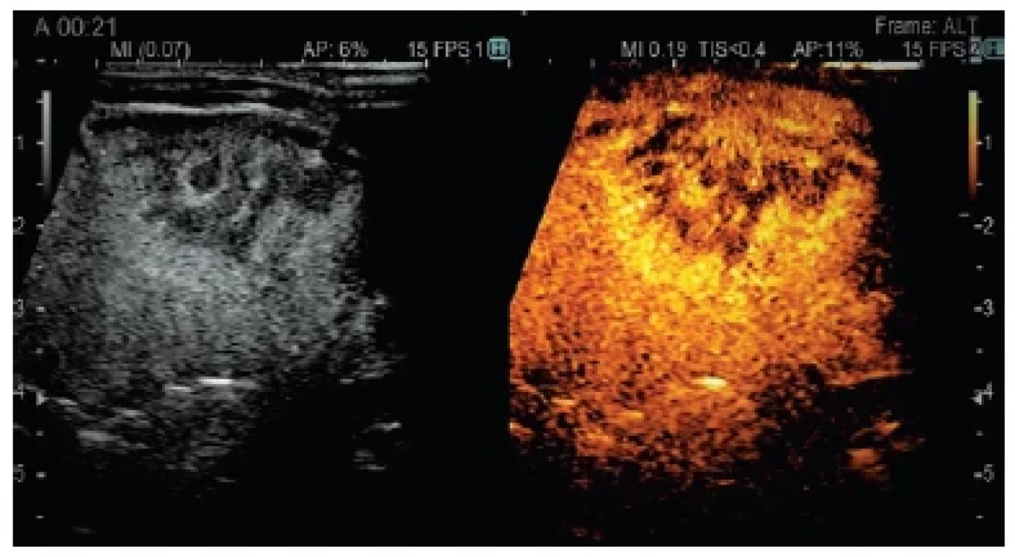Hepatoblastóm – CEUS arteriálna fáza