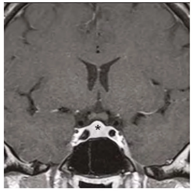 Kontrolní magnetická rezonance mozku (frontální řez v postkontrastním
T1-váženém obraze) po 3 měsících substituční hormonální léčby,
hvězdička zobrazuje regresi hyperplazie hypofýzy