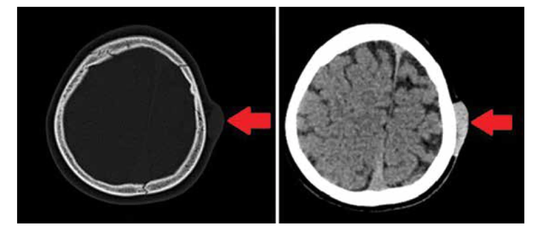 CT obraz oválnej mäkkotkanivovej tumoróznej lézie naliehajúcej na ľavú parietálnu kosť (vľavo natívny
obraz, vpravo po podaní kontrastnej látky). Lézia je dobre ohraničená, nedeštruuje priľahlý skelet ani ho
neuzuruje, nepropaguje sa do intrakránia (zdroj: archív autorov).<br>
Fig. 8. CT image of an oval soft tissue tumor lying on the left parietal bone (native image on the left side, on
the right side after an administration of contrast agent). The lesion is well demarcated, does not destroy the
adjacent skull and does not spread to the intracranial space (source: authors’ archive).