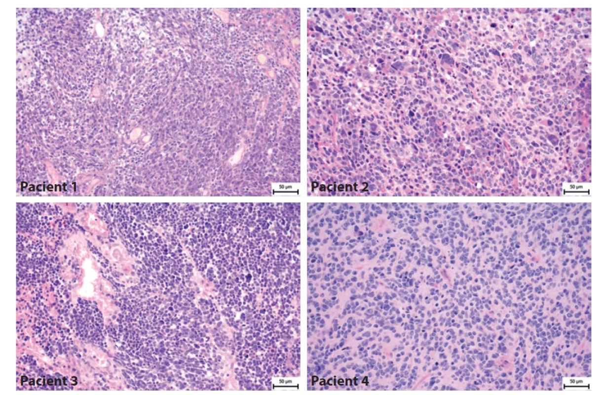 Histologický nález pacientů s meduloblastomem. Pacient 1- Klasický meduloblastom tvořený hustě nakupenými atypickými protáhlými
buňkami s oválnými jádry. Pacient 2 - Velkobuněčný/anaplastický meduloblastom tvoří kromě menších atypických buněk i četné obrovské
buňky s výrazně nepravidelnými jádry. Pacient 3- Velkobuněčný/anaplastický meduloblastom je složený jednak z oblastí vzhledu klasického
meduloblastomu, ale převažují úseky tvořené většími polygonálními buňkami s anaplastickými rysy a s velkými jádry místy s patrnými jadérky.
Pacient 4- Klasický meduloblastom tvořený atypickými protáhlými buňkami, které místy naznačeně tvoří rytmické struktury.