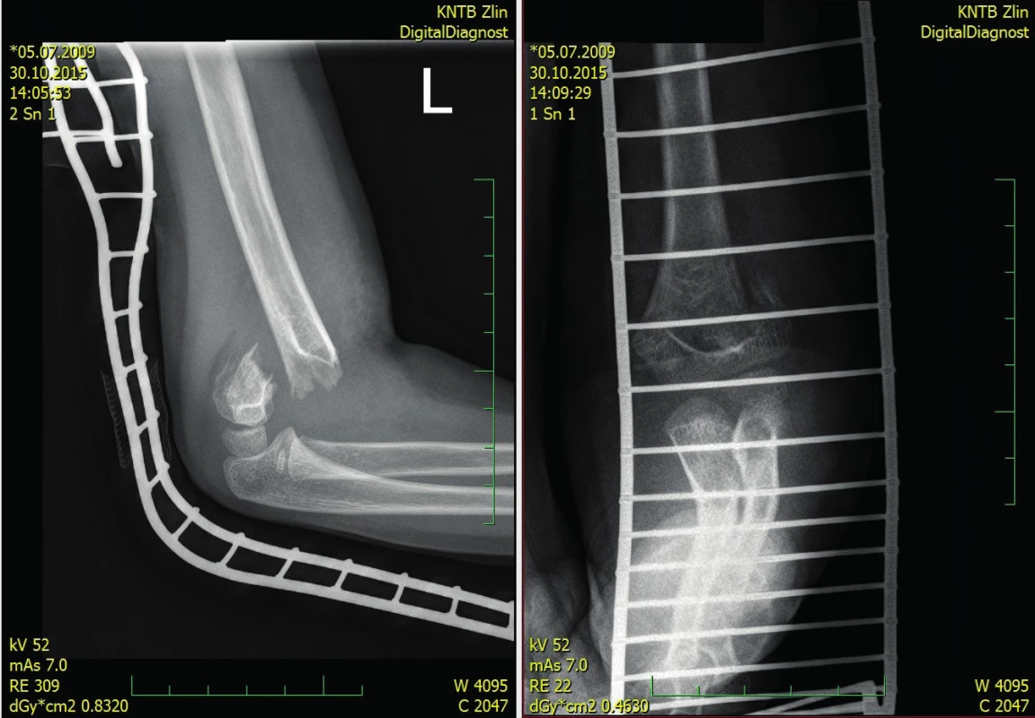 Dislocated type III fracture 