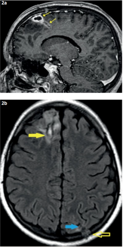 MR mozku před dimisí pacienta (30. 8. 2019).
a – Postkontrastní T1w sekvence v sagitální rovině:
Ložisko vpravo frontálně (žluté šipky; 32 x 15 x 11 mm)
ve výrazné parciální regresi, výrazná regrese perifokálního edému; b – Nativní FLAIR sekvence v axiální rovině:
Reziduum abscesu (žlutá šipka plná) vpravo frontálně
a vlevo okcipitálně (zde je již kolabovaná abscesová
dutina, modrá šipka plná), výrazná parciální regrese
perifokálního edému, úplná regrese defigurace střední
čáry, pooperační změny kalvy okcipitálně (otevřená žlutá
šipka).<br>
Fig. 2. Brain MRI before patient dismiss (30. 8. 2019). Frontal
right-sided abscess (32 x 15 x 11 mm) and perifocal
edema in regression.