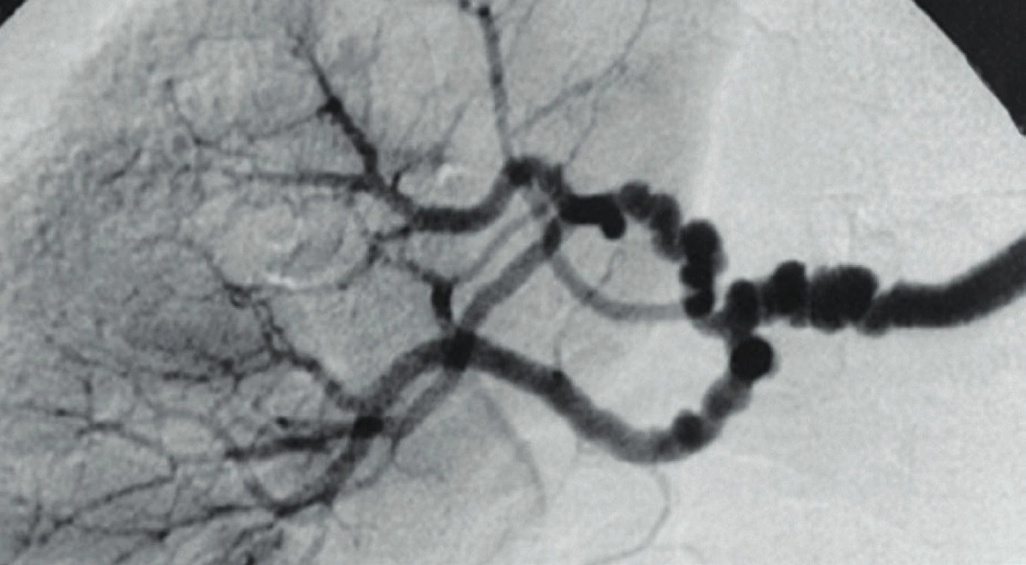 String of beads“ (retiazka korálok) – typický nález
v renálnej artérii [25].<br>
Fig. 7. String of beads – typical findings in renal artery [25].