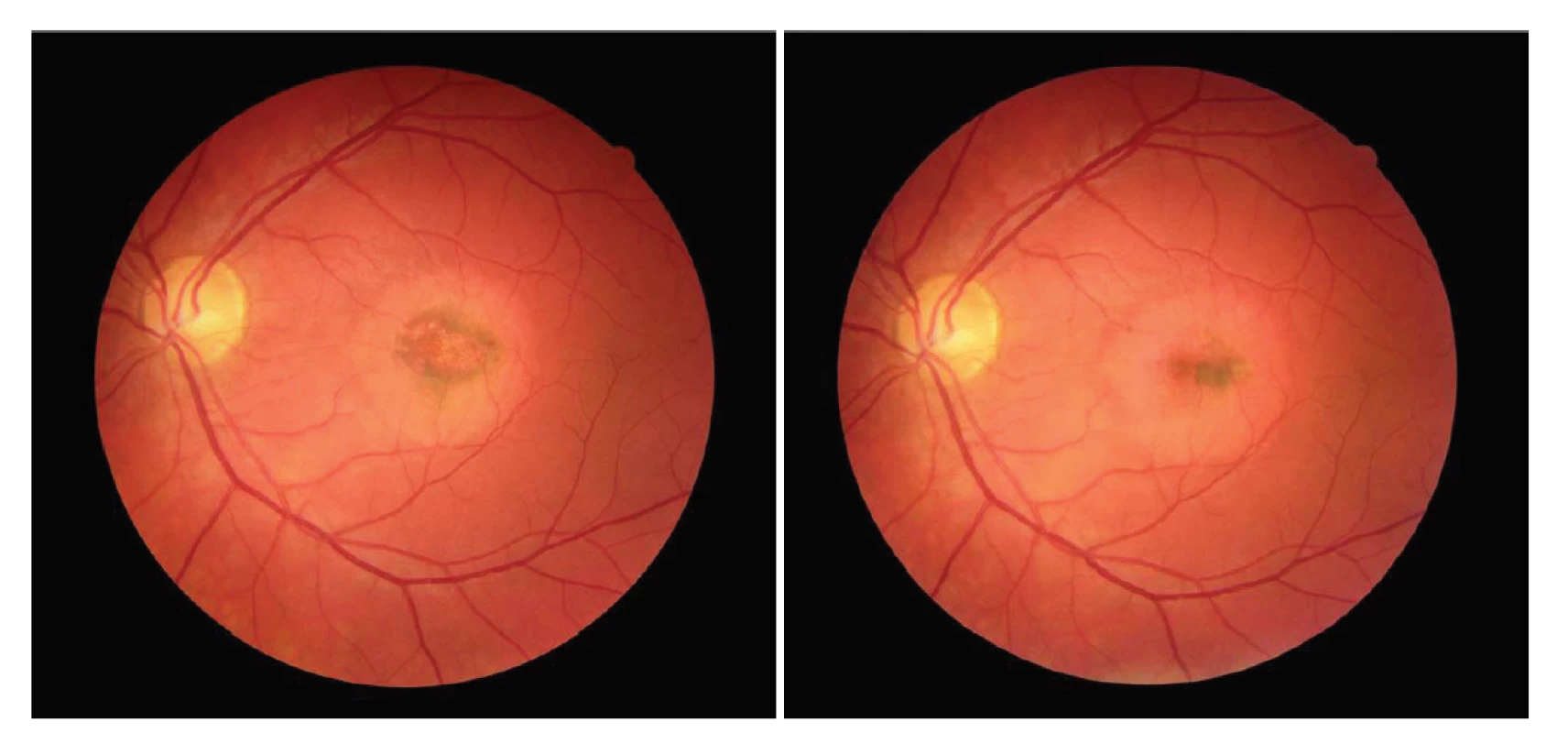 Snímek očního pozadí levého oka pacienta s chorioretinitidou (A), migrace pigmentu centrálně (B)