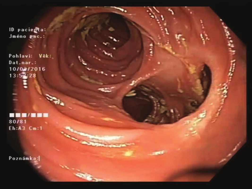 Endoskopický pohled na střevní anastomózu
(12 měsíců po zákroku)<br>
Fig. 2: Endoscopic view of the intestinal anastomosis
(month 12 after the procedure)