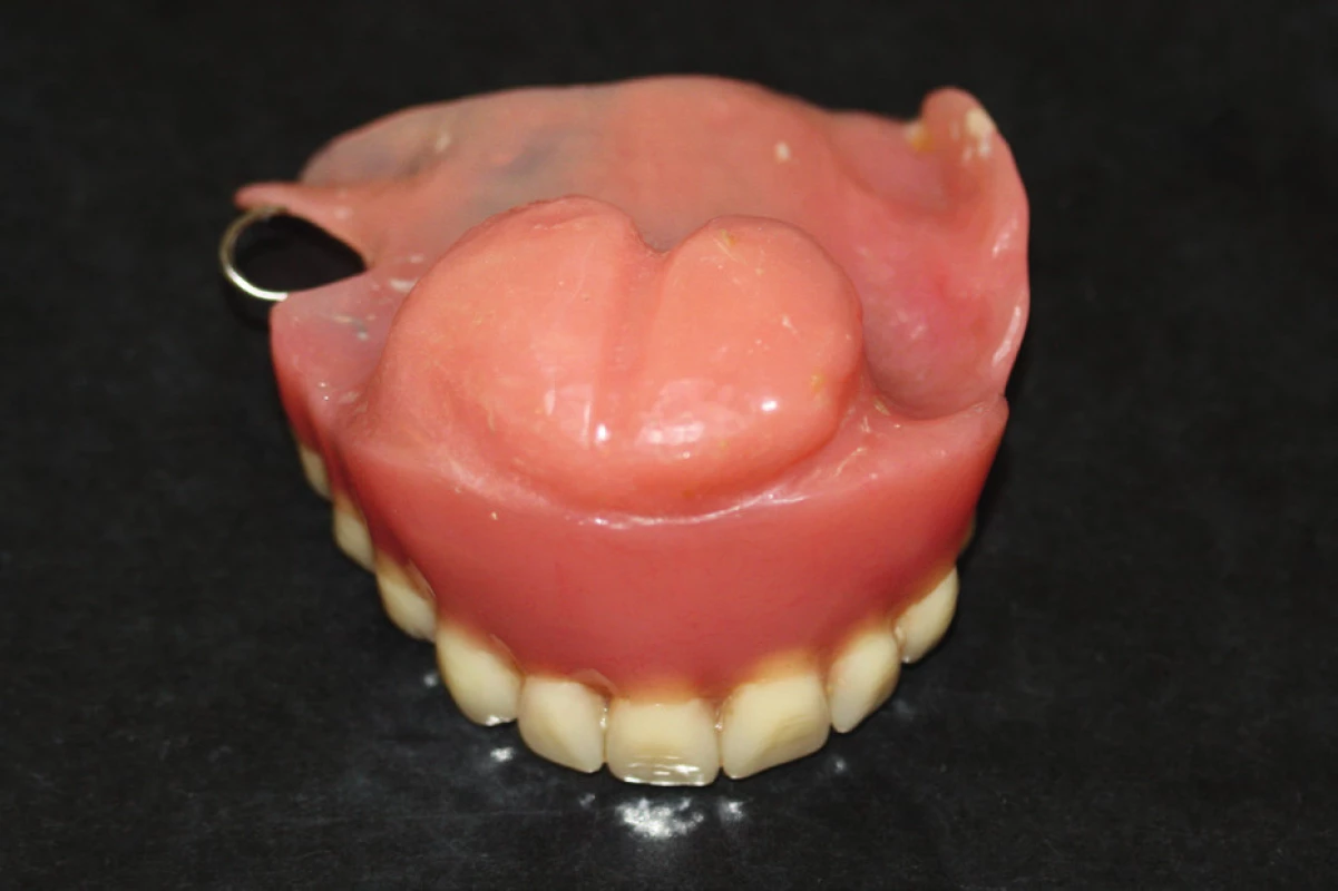 An obturator covering Ib. class defect of the maxilla and palate (author’s archive)